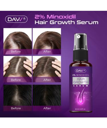 Women's 2% Minoxidil Hair Growth Serum with Biotin - Stop Thinning, Boost Hair Regrowth - 1 Month Supply (60mL) - Buy Online on GoSupps.com