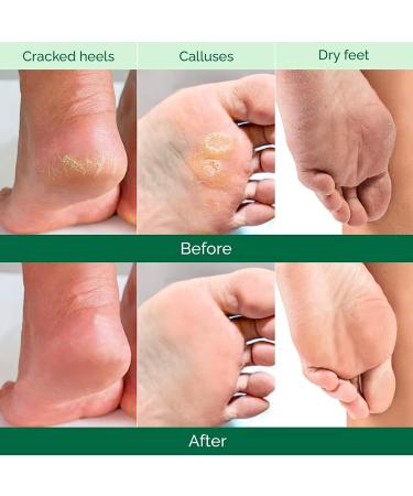 Niacinamide Serum Foot Peel Mask (3 Pairs) - Feet Peeling Mask For Baby Soft Skin Remove Dead Skin Dry Cracked Feet & Callus Spa Hard Skin Remover Foot For Women And Men Peeling Exfoliating Socks - Buy Online on GoSupps.com