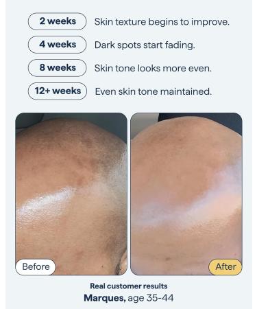 Remedy for Dark Spots | Advanced Night Treatment with Retinol & Kojic Acid | For Discoloration and Uneven Tones | With Glutathione Niacinamide Mandelic Acid | By Dermatologist Dr. Shah 1 fl. oz - Buy Online on GoSupps.com