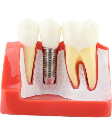 Implant Model Resin Dental Demonstration Demonstration Tooth Model Teeth Model Science Homework for Teaching Model School Dentist - Buy Online on GoSupps.com