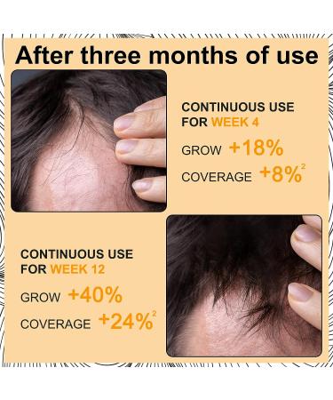 5% Minoxidil Foam Hair Regrowth Treatment for Men & Women - Stops Hair Loss, Promotes Follicle Growth - 2.11fl oz - Buy Online on GoSupps.com