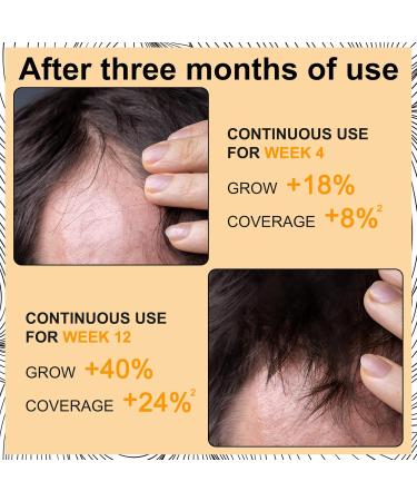 Buy Hair Growth Foam for Men & Women | With Biotin & Capilia Longa | Effective Hair Regrowth Treatment for Thicker Stronger Hair | Stop Hair Thinning - Buy Online on GoSupps.com