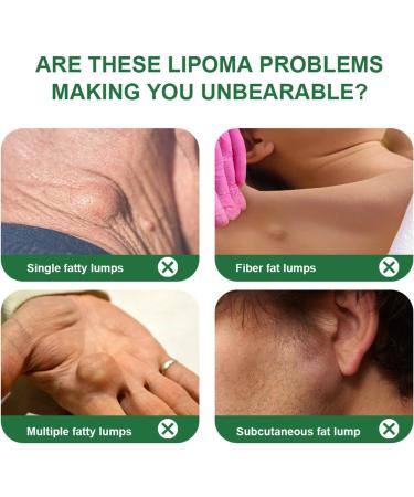  limination Des Lipomes 30g limination Douce Des Lipomes Pommade Apaisante pour la Peau Pour Visage Corps Articulations Jambe Bras Dos Routine Quotidienne Nuit Voyage Massage - Buy Online on GoSupps.com