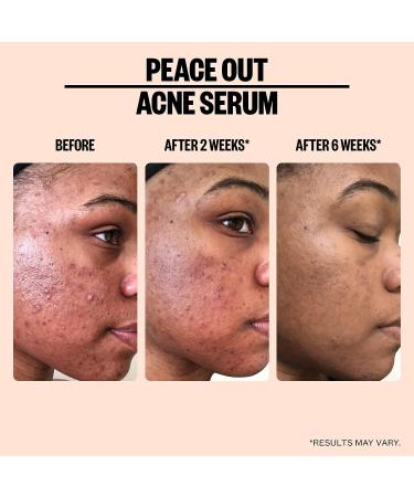 Peace Out Skincare Acne Serum - 2% Salicylic Acid Face Serum for Pimples, Zits, Blemishes | Clearer Skin | 1 fl oz - Buy Online on GoSupps.com
