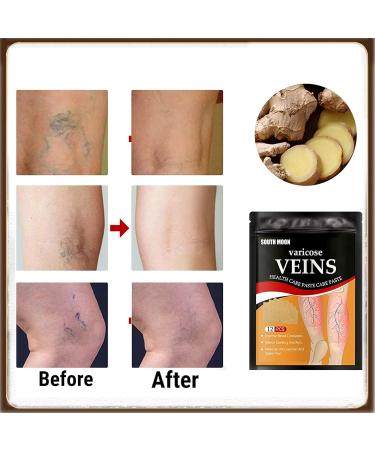 24 PCs Varicose Vein Patch | Remove Spider Veins & Improve Leg Appearance | Enhance Blood Flow & Relieve Inflammation | International Shipping Available - Buy Online on GoSupps.com