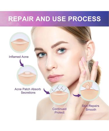 144Pcs Acne Stickers for Home, Irregular Shape Pimple Elimination - Acne Patches - Buy Online on GoSupps.com