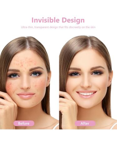 Dohia Pimple Patches - Hydrocolloid Acne Absorbing Cover for Face & Body | Invisible Tea Tree & Calendula Oil | 80 Patches - Buy Online on GoSupps.com