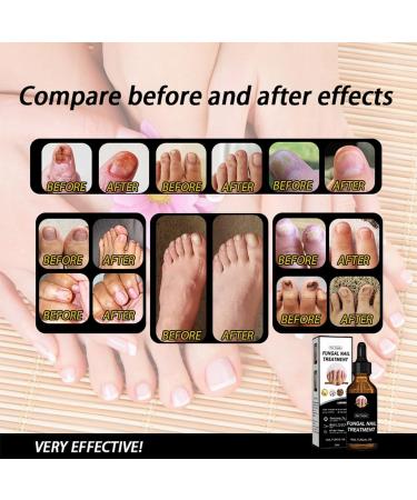 CAOQAO Nail Fix Solution Thickened Bright Nails To Get Rid Of Nail Dead Skin Fix Moisturizing Nail Nutrition Care Solution 30ml Nail Suction (B One Size) 1 count (Pack of 1) B - Buy Online on GoSupps.com