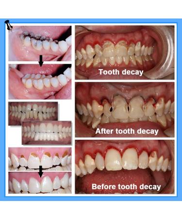 Tooth Repair Kit: 3 Moldable Denture Options for Missing or Broken Teeth with Basics+Thermal Beads - Buy Online on GoSupps.com