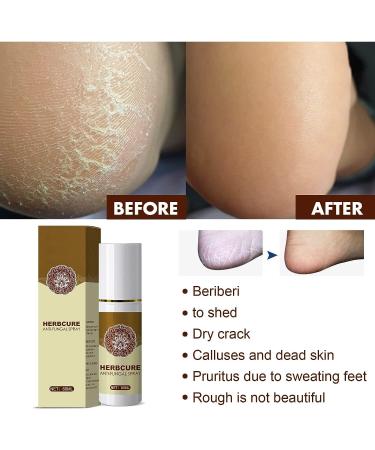 Fungal Combat Feet Spray- 3 Pcs Anti-Fungal Infections Athlete's Foot Herbal Peeling Spray 60ml - Buy Online on GoSupps.com