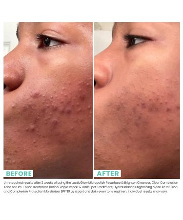 Urban Skin Rx Clear Complexion Acne Serum + Spot Treatment | 5% Benzoyl Peroxide & 5% Glycolic Acid | 1 fl oz - Buy Online on GoSupps.com