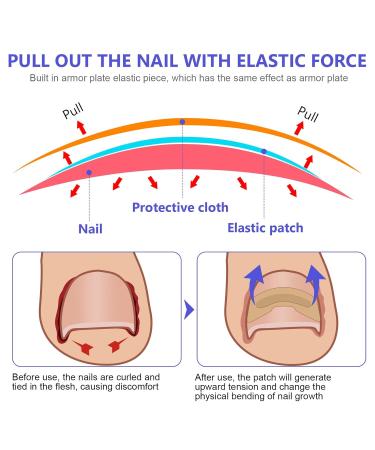 Ingrown Toenail Treatment - Painless Corrector Strips & Nail Correction Patches | 100 Pcs - Buy Online on GoSupps.com