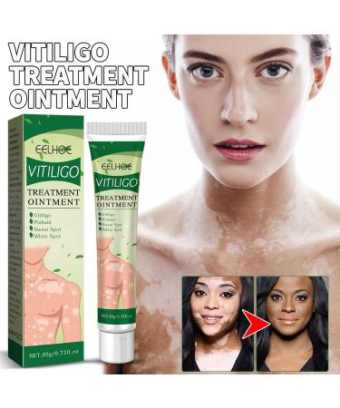  Bexdug Cream | 20 herbal ointments Moisturizing cream for skin leukoplakia white spots on the skin - Buy Online on GoSupps.com