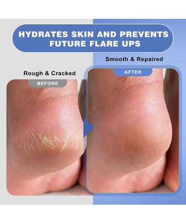 Tea Tree Oil Antifungal Cream - Athletes Foot, Jock Itch, Ringworm Treatment - Hydrating Anti Fungal Cream for Itchy Skin Relief - Buy Online on GoSupps.com