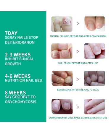 Kerassentials Toenail Oil for Stronger and Healthier Nails (Colorless 3P) - Buy Online on GoSupps.com