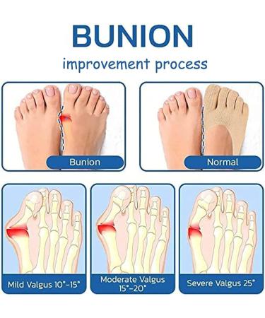 EXQST Anti Bunions Health Sock 5-Pair Set for Women - Bunion Corrector & Toe Alignment Relief Socks - Breathable One Size Fits All - Buy Online on GoSupps.com