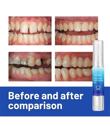 Furzero Oral Gel - 2 Pack Gum Treatment for Effective Gum Protection Therapy - Buy Online on GoSupps.com