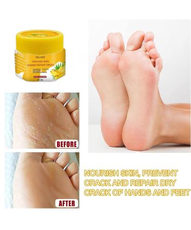 Horn Skin Remover & Cup Ointment | Anti-Cornea & Dry Skin Foot Cream for Men & Women | Intensive Care for Cracked Skin - 2PCs Yellow - Buy Online on GoSupps.com