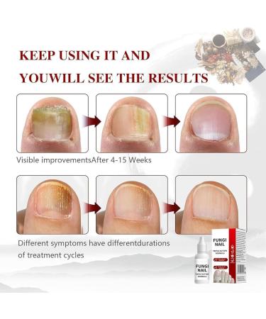 Nail Health | 15 ml Manicure and Cuticle Softener | Cuticle Softening Gel | For the treatment of damaged nails and yellow cuticles - Buy Online on GoSupps.com