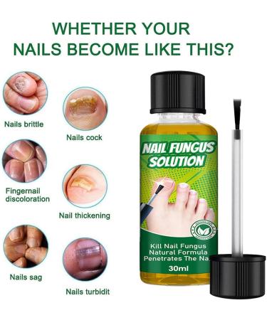 ERFD Toenail fungus care Fungal Nail Cure for Toenails Extra Strong 30ml Anti Fungal Toe Nails Treatment - Buy Online on GoSupps.com