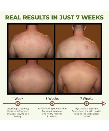 ABERA Folliculitis Shower Gel with Wild Bitter Melon Extract Reduces Back Acne & Hyperkeratosis Supports Clearer-Looking Skin & Smooth Texture 2 Boxes + Gift Hair Regrowth Shampoo - Buy Online on GoSupps.com