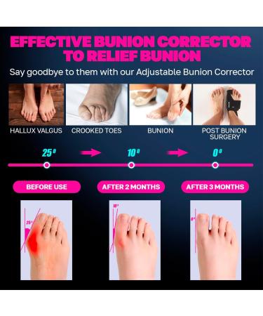 Effective Bunion Corrector Kit for Men & Women | Relief Sleeves to Straighten Toes & Correct Bunions - Buy Online on GoSupps.com
