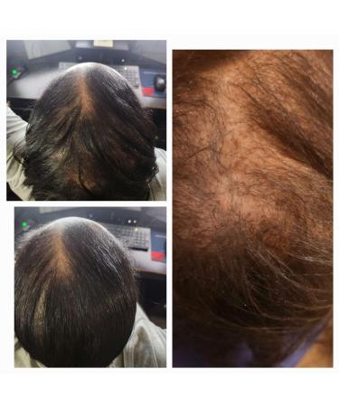 Glory Moringa Hair Growth Butter - Nourish & Stimulate Healthy Hair Growth | International Shipping Available - Buy Online on GoSupps.com