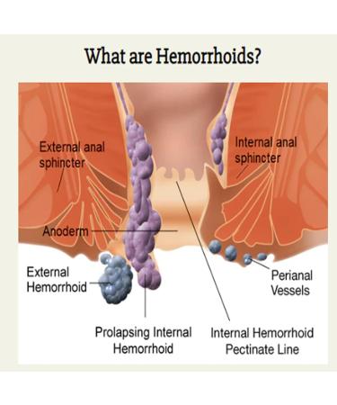 URNOS Heca Natural Herbal Hemorrhoid Capsules - Rapid Relief Treatment for Men & Women - 5 Box Set - Buy Online on GoSupps.com