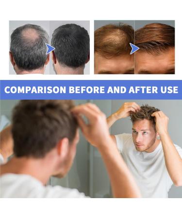 KOAHDE Hair Regrowth Foam for Men Hair Regrowth Spray Foam Hair Growth Foam Anti Hair Loss Foam Thinning Hair Foam for Men Hair Regrowth Treatment for Men Hair Growth Serum for Men Hair Loss Serum - Buy Online on GoSupps.com