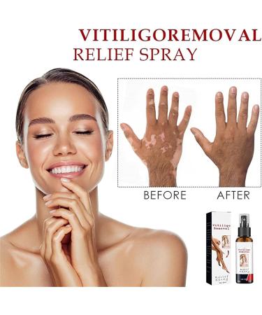 Vitiligo Treatment Spray - Skin Pigmentation Care & White Spot Reduction (2pcs) - Buy Online on GoSupps.com