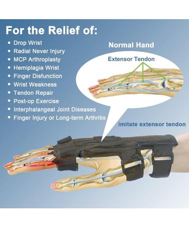 Feamero Radial Nerve Palsy Splint - Adjustable Finger Lift Arm Brace for Drop Wrist & Nerve Injury - Unisex Fit - Left & Right Hand - Buy Online on GoSupps.com