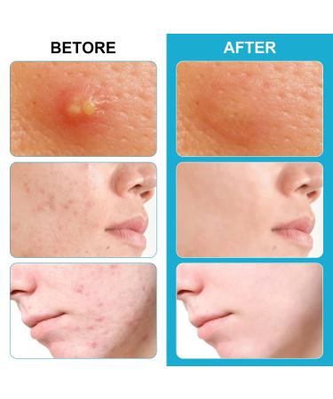 Jonov Acne Pimple Patch - Fast Acting Hydrocolloid Pimple Patches for Night - 18 Blemish Cover Stickers for Face - Buy Online on GoSupps.com