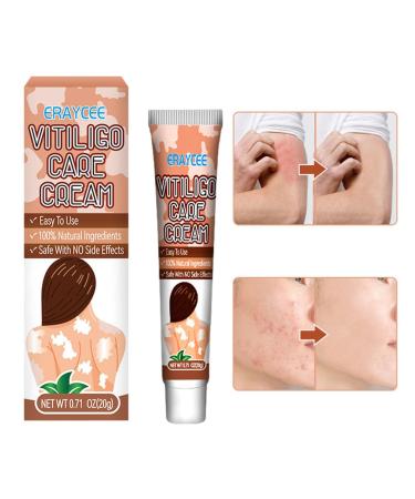 Hongjingda Skin lightening cream for vitiligo - 20g vitiligo relief cream for white patches on the skin reduces white patches improves epidermal melanocytes Hongjingda