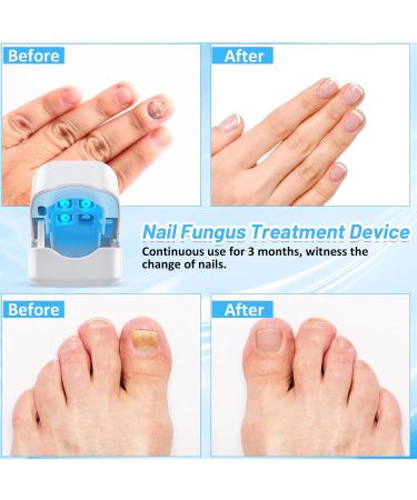Portable Nail Fungus Laser Treatment Device | Light Therapy for Onychomycosis | Painless Home Use - Buy Online on GoSupps.com