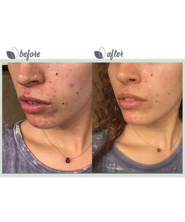 bioClarity 3-Step Acne Routine for Oily/Acne-Prone Skin | 100% Clean Vegan Ingredients - Buy Online on GoSupps.com