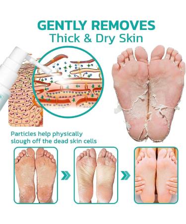 Professional Callus Remover Extra Strength Spray Foot Callus Removal Spray Foot Peeling Spray for Remove Dead Skin and Calluses on Feet (1Pcs) - Buy Online on GoSupps.com