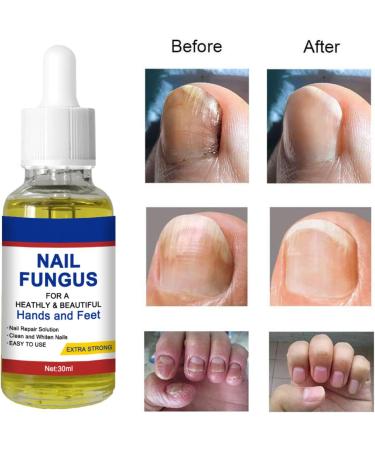 Nail Fungal Treatment Toenail Treatment Extra Strong Nail Repair Set Fingernail Toenail Care Fix Renew Damaged Broken Anti Fungus Nail Repair - Buy Online on GoSupps.com