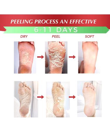 Exfoliating Foot Peel Mask For Softer Smooth Feet- Gently Peel Away Calluses & Dead Skin Repair Rough Heels Get Beautiful Baby Feet in 7 Days (2 Pack) - Buy Online on GoSupps.com