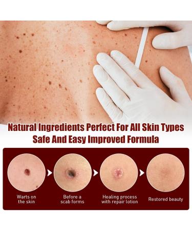 Wipe Off Moles & Skin Tags Remover Pen - Natural, Non-Irritating Formula for Easy Removal on Face & Body (2 PCS) - Buy Online on GoSupps.com