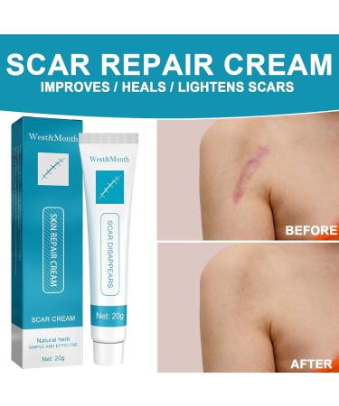 Advanced Scar Removal Cream for Old Scars - Targets Stretch Marks, Acne, Surgery, Burns & Injuries - Suitable for All Skin Types - Buy Online on GoSupps.com