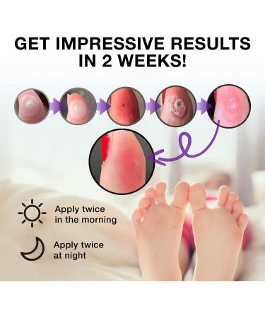 Pureskin Extra Strength Liquid Corn Remover for Toes and Feet - Callus Removal Treatment - Buy Online on GoSupps.com