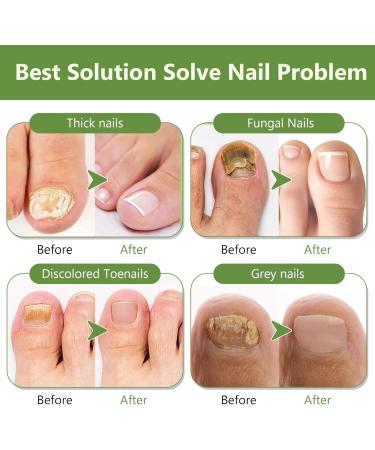 Toenail Care with Nail File Nourishing and Soothing for Nails Promotes the Regrowth of Healthy Nails 30ml - Buy Online on GoSupps.com