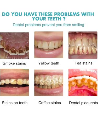 Instant Teeth Whitening Gel | Brighten Smile Remove Stains & Freshen Breath | International Shipping - Buy Online on GoSupps.com