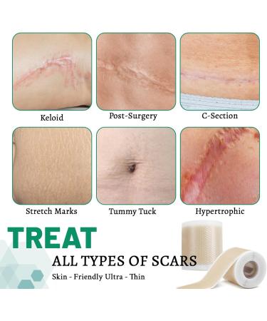 3 Rolls Silicone Scar Sheets(1.6" x 60" Each) Silicone Patches for Scars Reusable Scar Removal Strips for Prevention and Repair - Buy Online on GoSupps.com