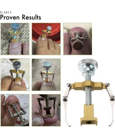 GLAMZA Ingrown Toenail Corrector Clamp - Safe & Effective Treatment Tool - Buy Online on GoSupps.com