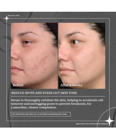 TITIMORE 2% Salicylic Acid Serum For Acne Treatment Liquid Salicylic Acid Exfoliating Essence for Whiteheads Blackheads Minimize Pores Uneven Skin Reduces Pimples Skin Barrier Repair - Buy Online on GoSupps.com