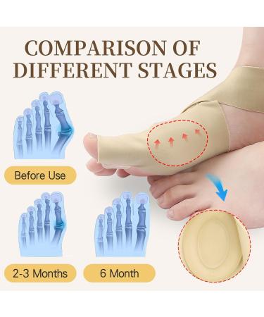 Bunion Correctors for Big Toe Pain Relief | Non-Surgical Hallux Valgus Support for Men & Women - SEBS Cross Strap Separator in Khaki - Buy Online on GoSupps.com