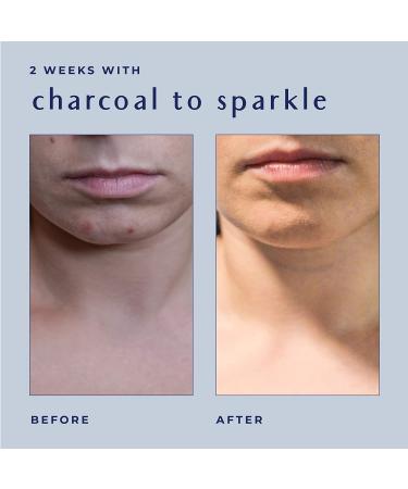 Ayadara Cystic Hormonal Acne Charcoal Face Wash - Deep Cleansing Sulfur Cleanser for Oily Skin - Prevents Breakouts, Inflamed Pores & Dark Spots - 8 Fl Oz (Pack of 1) - Buy Online on GoSupps.com