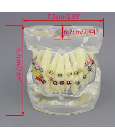Shop Dental Malocclusion Orthodontic Treatment Model - Metal Brackets & Colorful Ties | M3005 - International Shipping Available - Buy Online on GoSupps.com