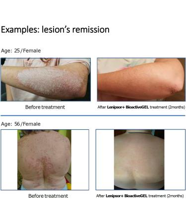  Lenipsor+ BioRelax Body and Hair Wash 30ml Helps treat psoriasis - Buy Online on GoSupps.com